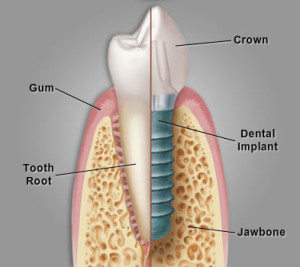 image of how a dental implant mimic a real tooth
