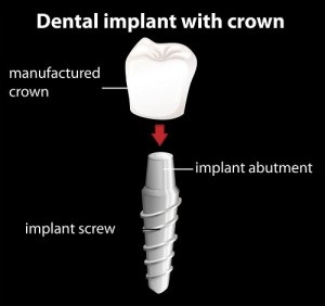 Implant-Breakdown
