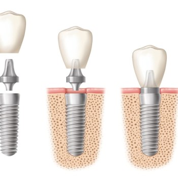 how to place dental implant into a jaw