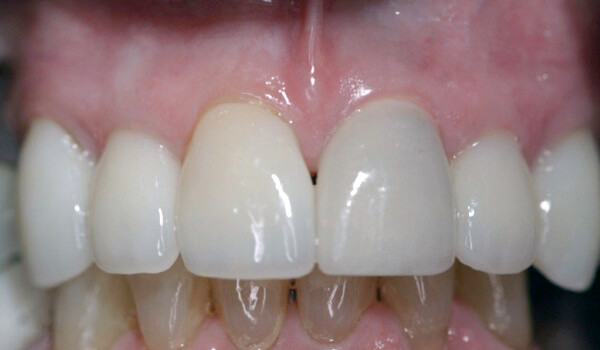 Single Tooth Implant After Photo