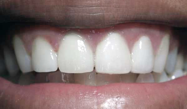 Implant and Crown After Photo