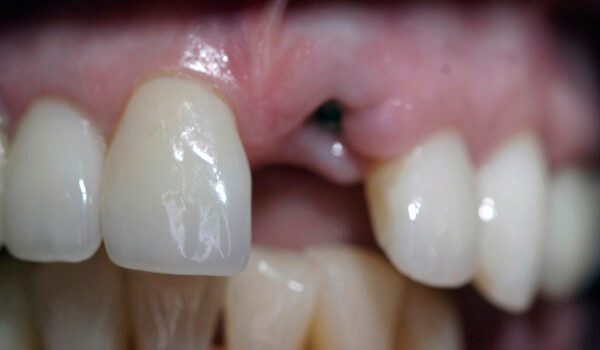 Single Tooth Implant Before Photo