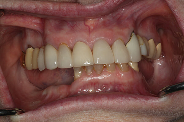 Implant Supported Overdenture Before Photo