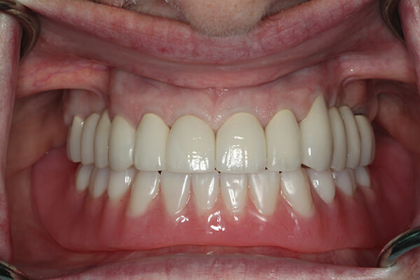 Implant Supported Overdenture After Photo