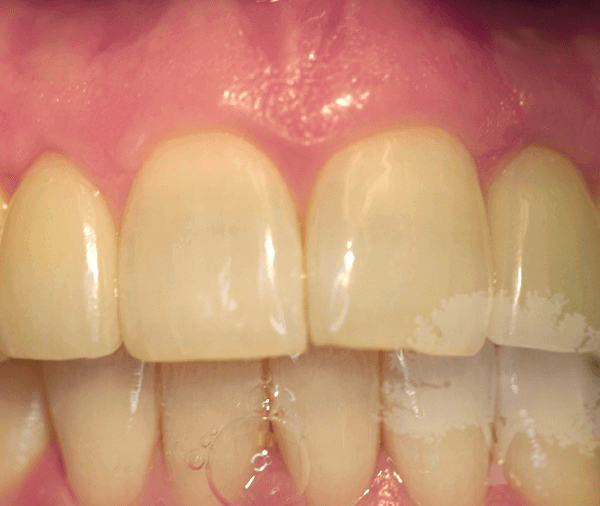 Single Tooth Implant Placement After Photo