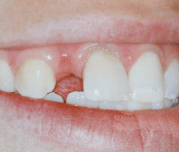 Implant without Grafting Before Photo