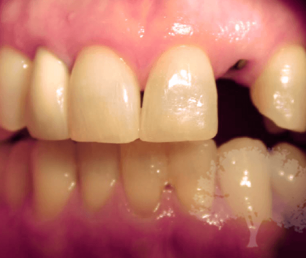 Single Tooth Implant Placement Before Photo