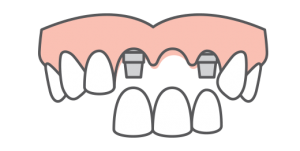 a bridge of dental implant tooth replacement